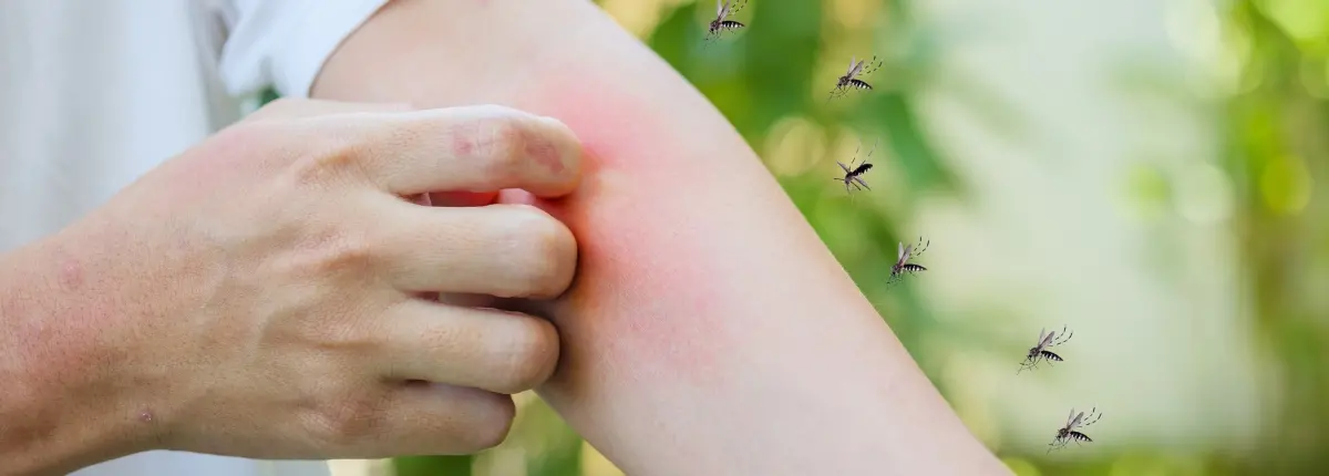 Zanzare utili ma fastidiose: una puntura di zanzara sul braccio